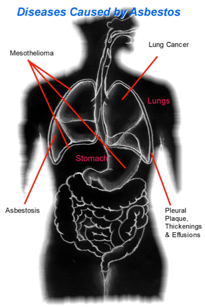 Asbestos Audits Queensland -AAQ PL - Disease Cause by Asbestos